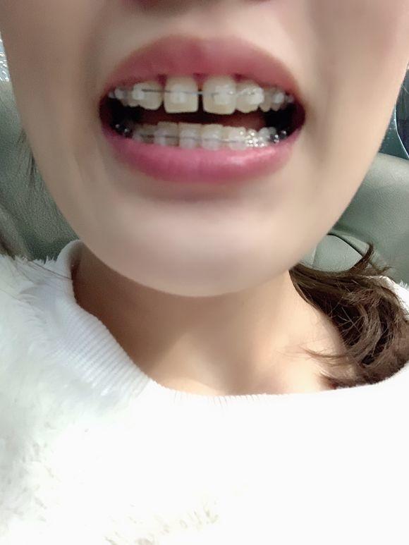 牙套日记一年级,牙套日记在线观看