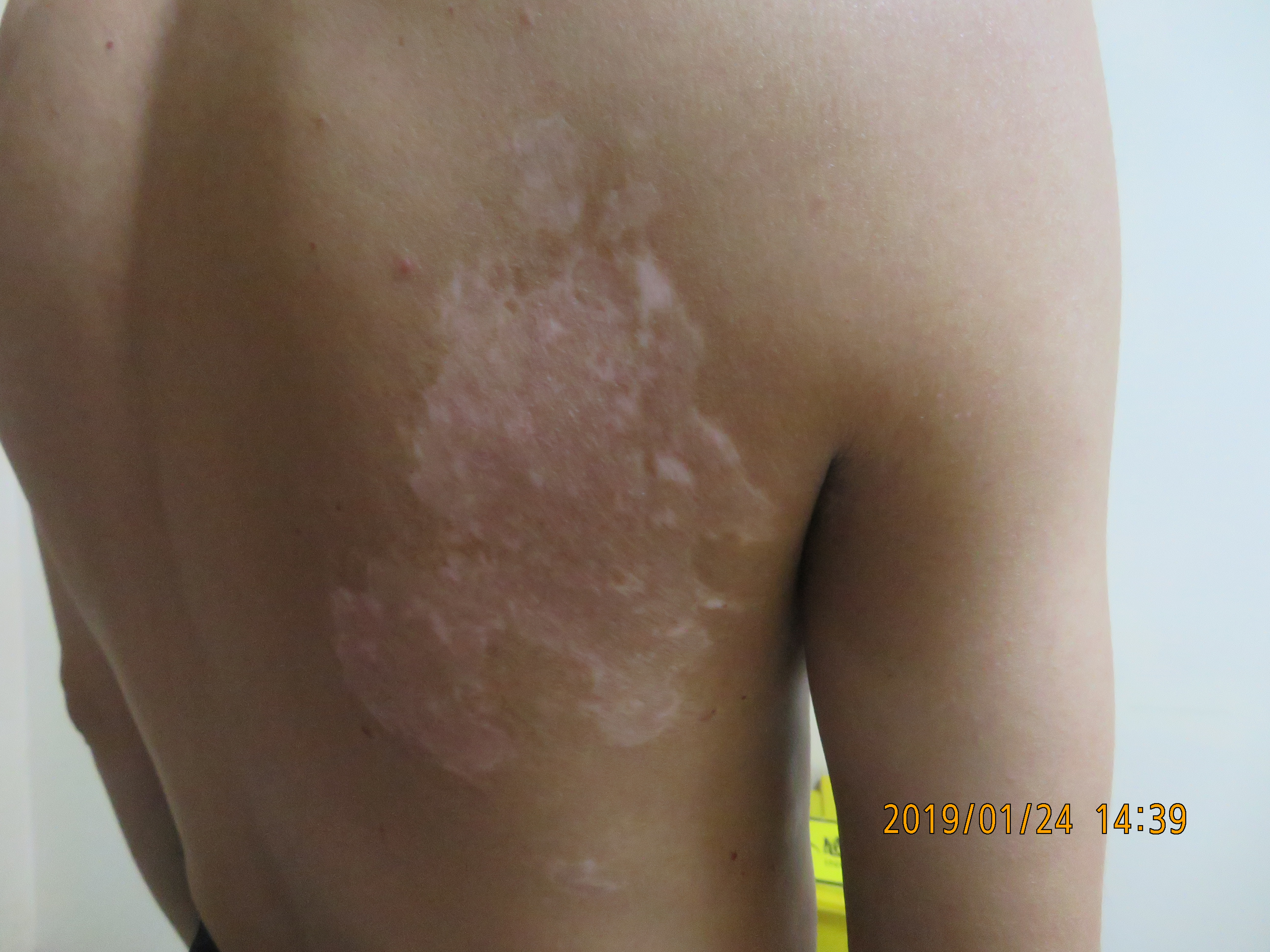 白癜风uvb光疗效果,uvb光疗仪治疗白癜风对皮肤的危害