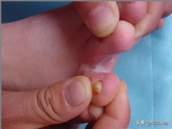 夏季脚气的最佳治疗方法,夏季脚气重是怎么回事