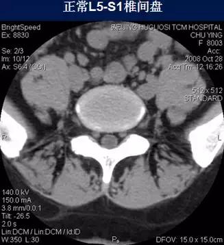 腰椎退行性变腰椎间盘轻度突出,椎间盘突出并膨出继发椎管狭窄