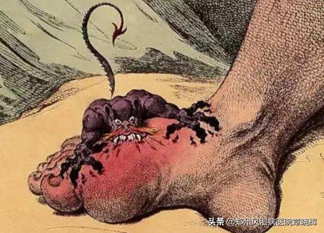 痛风的十大误区不得不看,痛风的100个误区