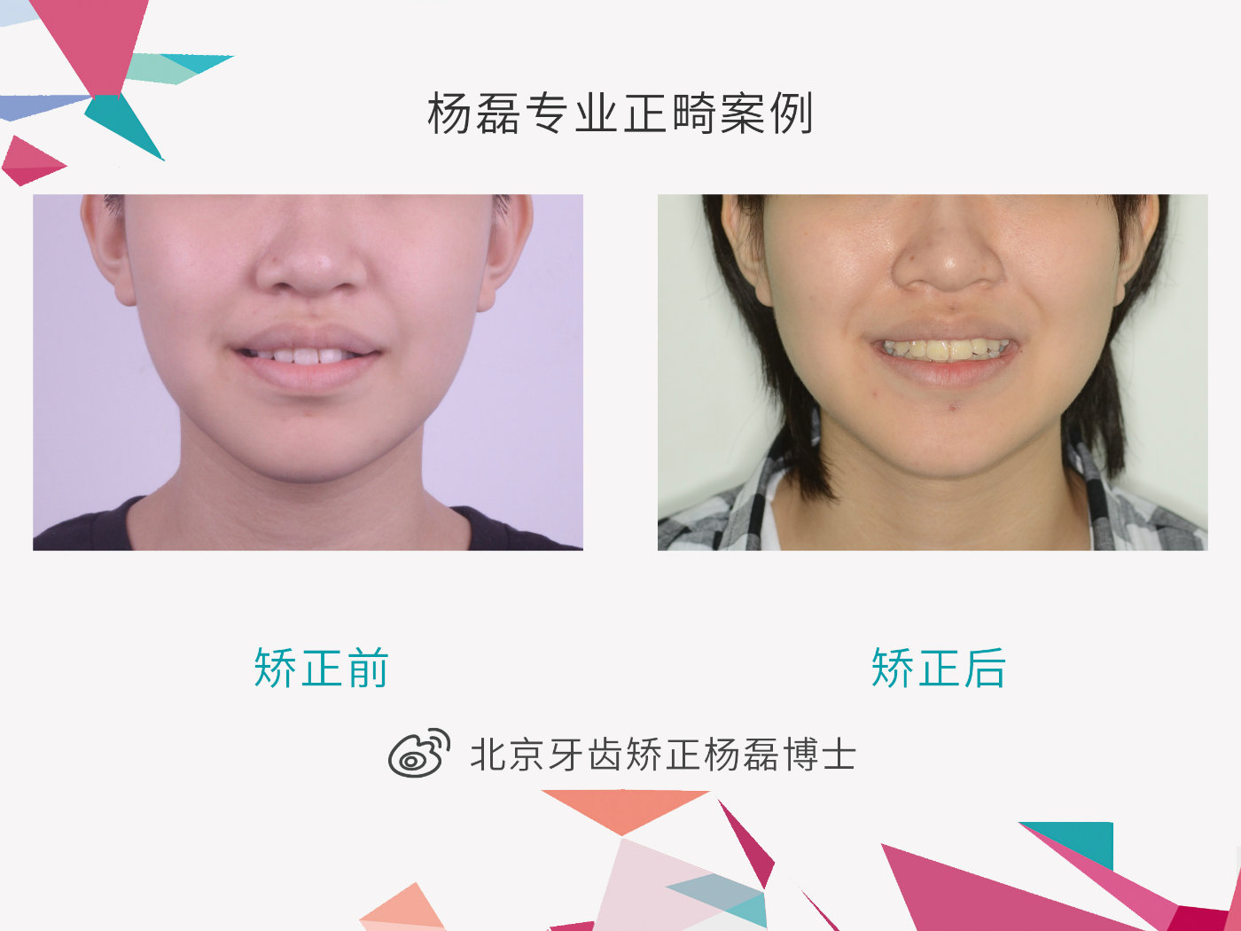 正规的北京牙齿矫正方案,牙齿矫正北京口腔医院