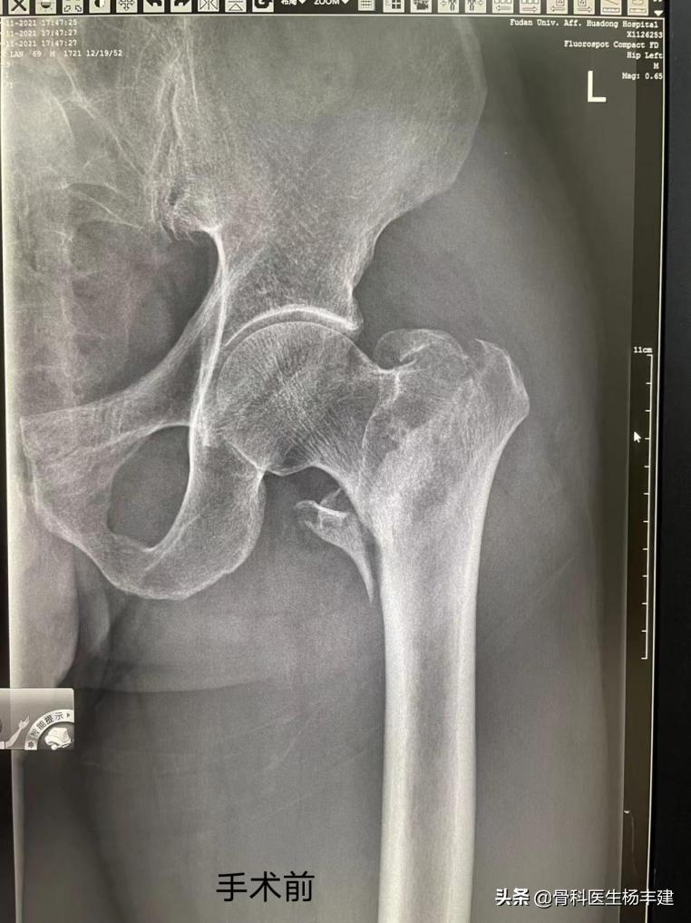 老人摔骨折多长时间能正常走路,老人摔倒哪种骨折最可怕