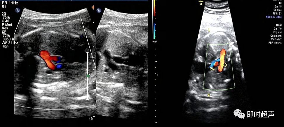 胎儿心脏三种血管关系模式图,25周的胎儿心脏弓切面多少正常