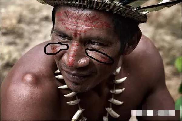 皮肤衰老了，长了印第安纹怎么办？