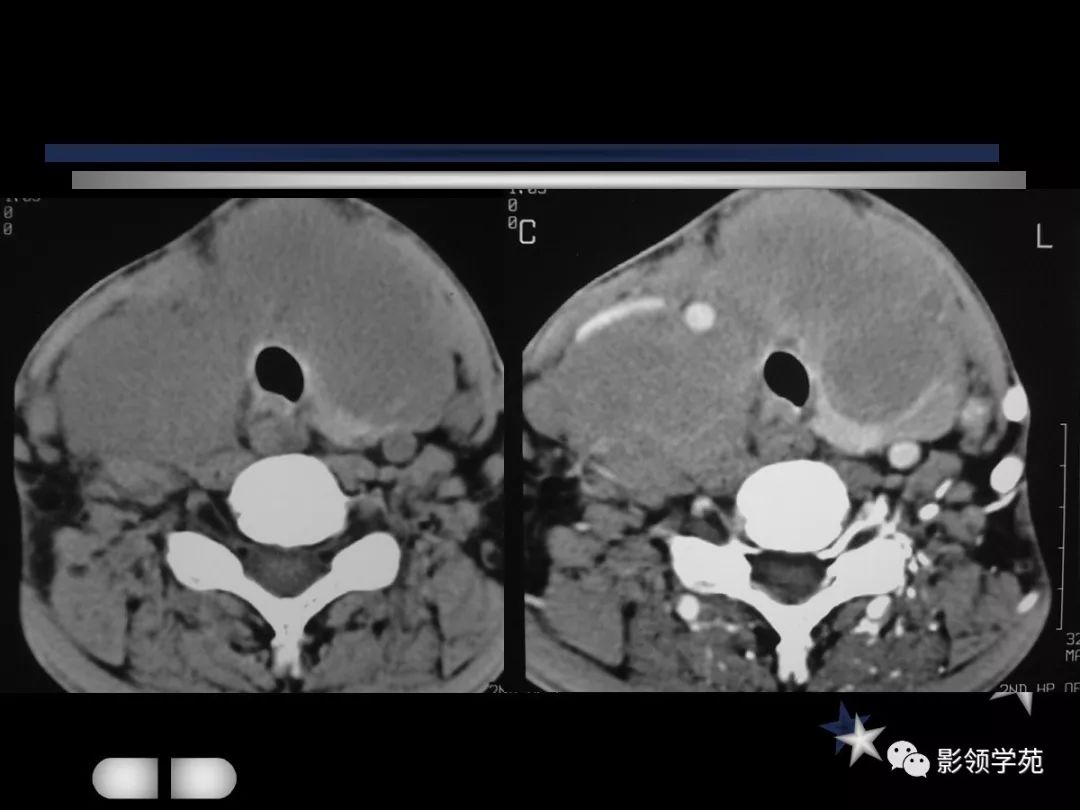 腮腺疾病影像学诊断,腮腺肿块影像诊断
