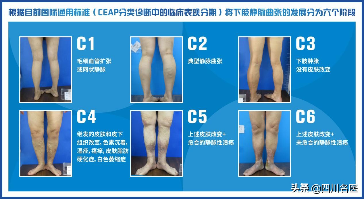 静脉曲张的致残率,静脉曲张最终会是什么结局