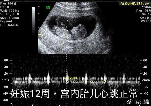 双胞胎一个宫内一个宫外大出血,双胞胎一个流产一个宫外孕