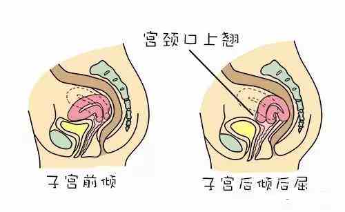 子宫位置会影响受孕?妇产医生授你怀孕秘籍