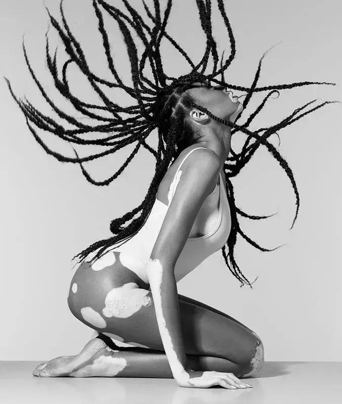 全身黑斑被骂“斑点狗”，身高160的她却成为最美超模…