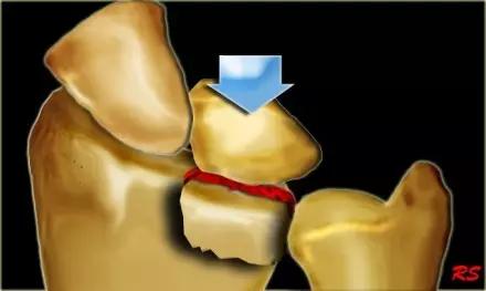 所有骨折都叫什么名字,骨折的名称有哪些