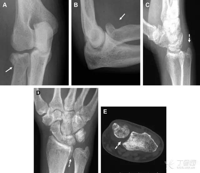 值夜班急救措施,放射科容易漏诊的骨折