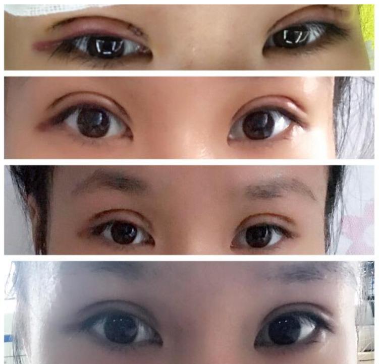 三分钟学会双眼皮,割双眼皮9秒带你看