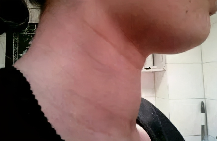 全国甲状腺知识宣传周,国际甲状腺知识宣传周央视