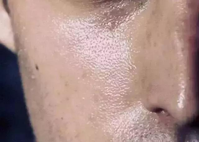 螨虫把皮肤毛孔弄得越来越大,脸上反反复复长螨虫毛孔还大