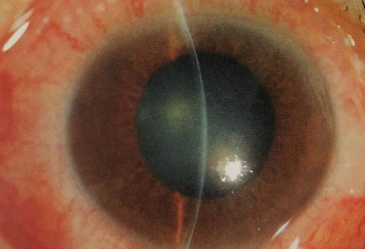 青光眼头晕恶心想吐怎么回事,南阳医专第一附属医院眼科怎么样