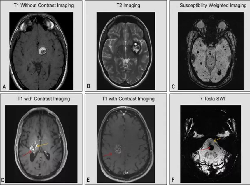 颅内海绵状血管瘤能治好吗,什么是颅内海绵状血管瘤