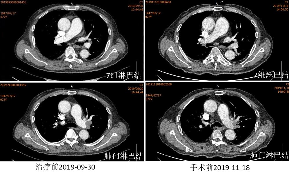 PD-1新辅助治疗初探，典型案例汇总一览