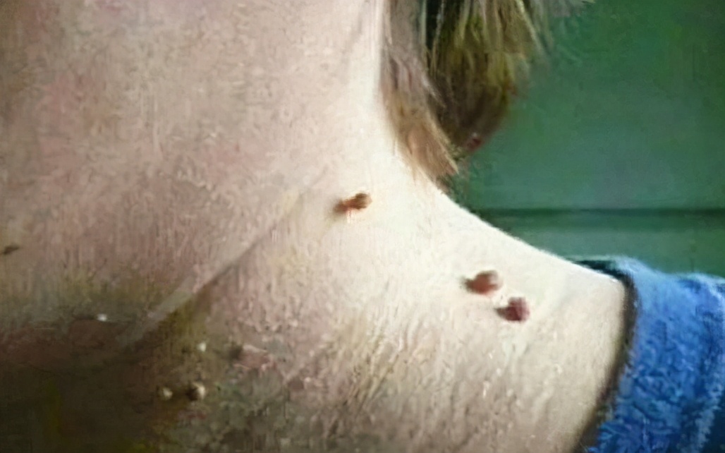 脖子上长的小肉粒揪下来会怎样,脖子和腋下长小肉球是什么原因