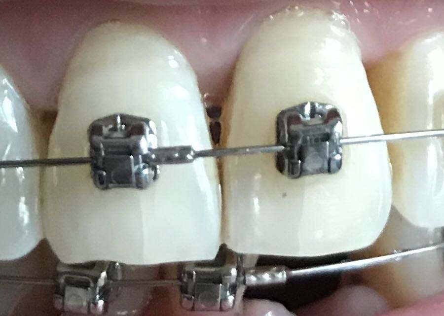 牙齿矫正能不能出现新的矫正方法,牙齿矫正一般是矫正什么情况