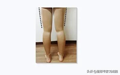 吸脂腿部的真实经历,腿部吸脂后悔者自述
