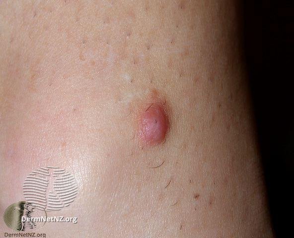 褐色皮肤纤维瘤会癌变吗,皮肤里面有个小的肿块会是什么