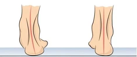 足弓不好的步态问题,如何改善足弓往里弯