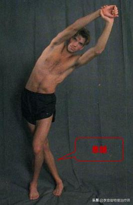 老生常谈跑步膝:髂胫束综合征(ITBS)