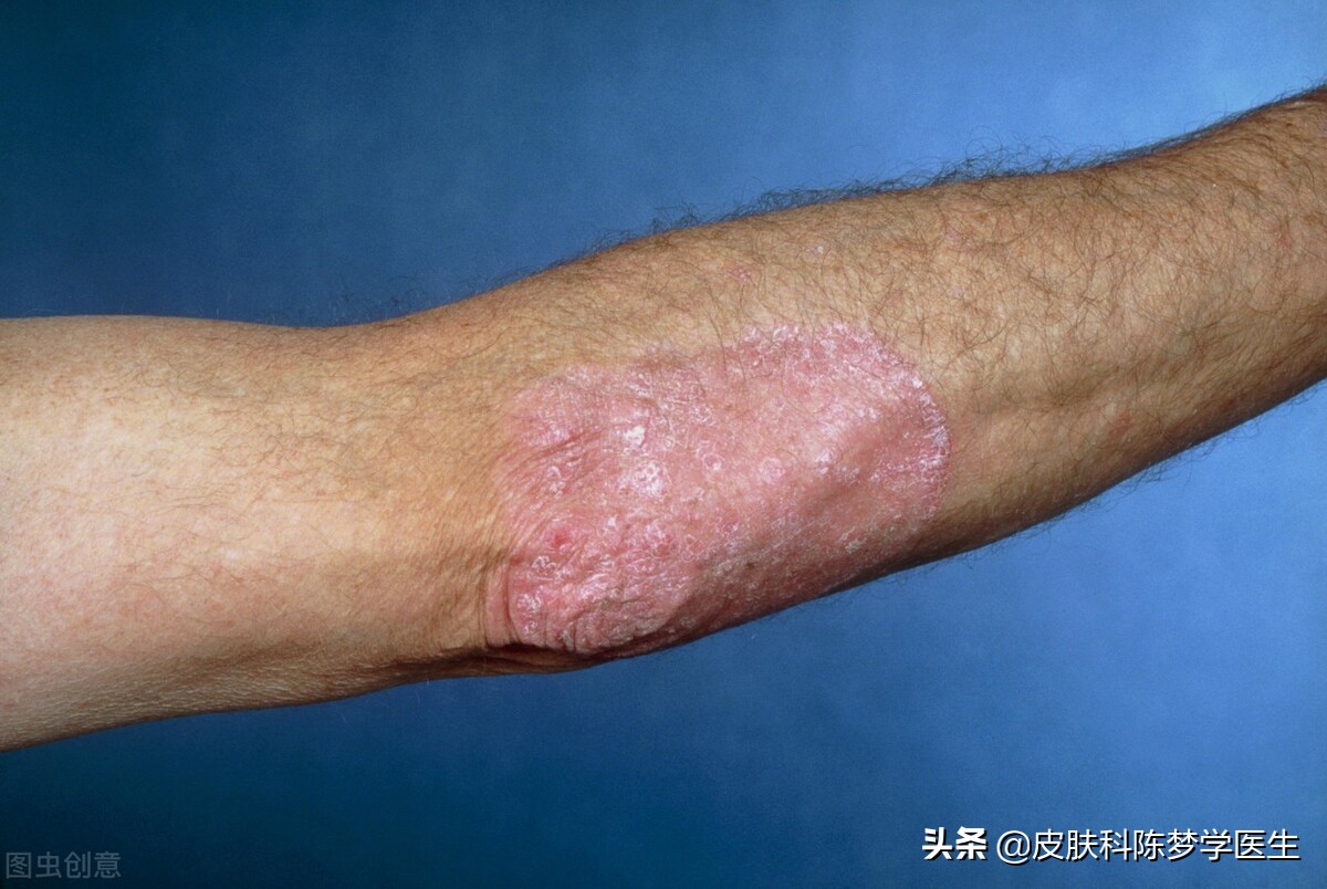 红色斑块脱屑一定是牛皮癣吗,皮肤上有癣起皮颜色呈褐色