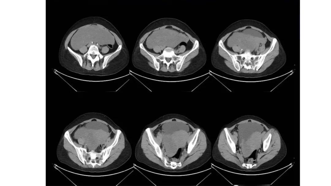 卵巢原发肿瘤的分析思路