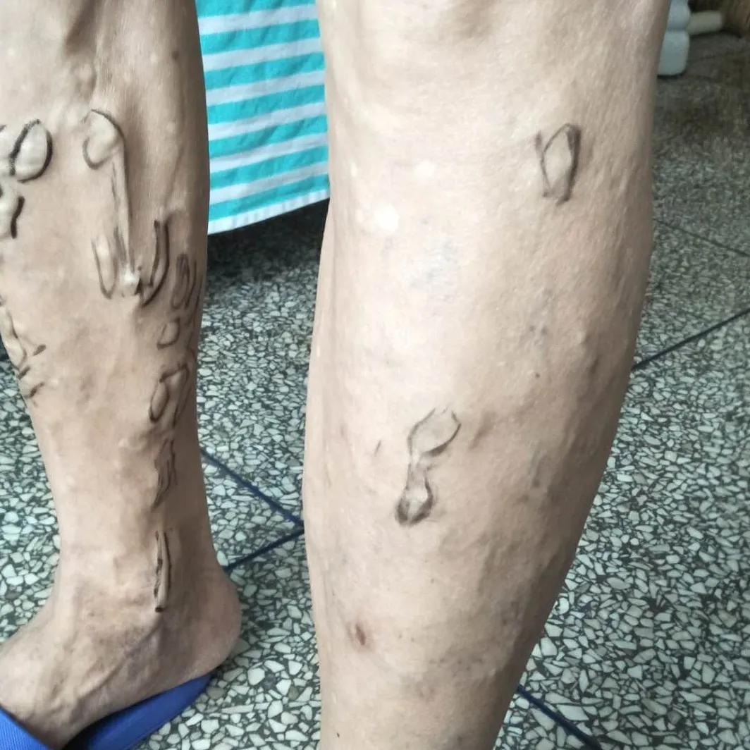 河北静脉曲张微创手术,邢台静脉曲张手术多长时间治好