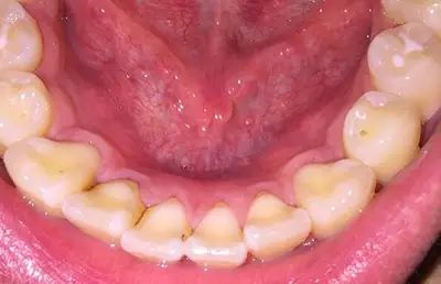 牙上有黑黑的东西又很疼,牙上有黑东西咋回事