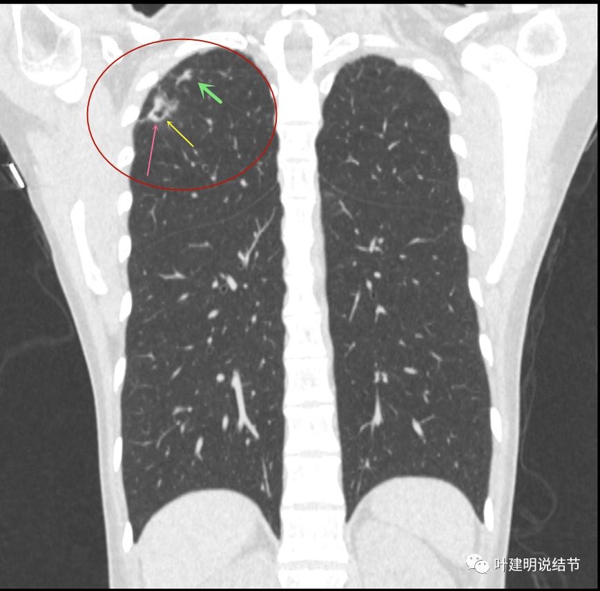 临床诊断孤立性肺结节,空洞型结节一般是什么性质