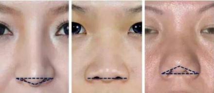 有哪些明星是朝天鼻,塌鼻好看的明星