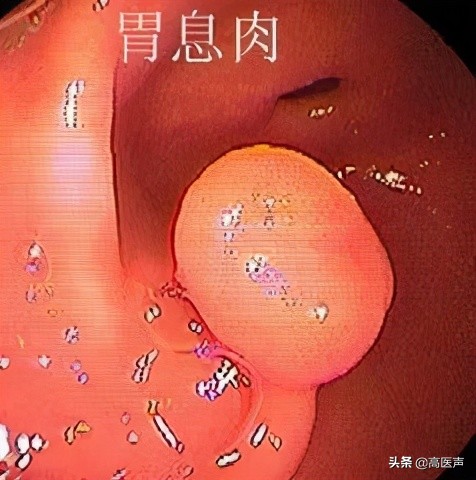 胃病胃糜烂看中医还是西医比较好,治疗胃病中医和西医哪个效果好