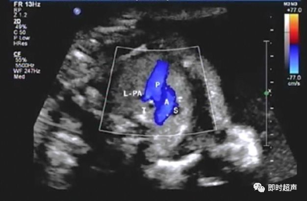 胎儿心脏三种血管关系模式图,25周的胎儿心脏弓切面多少正常