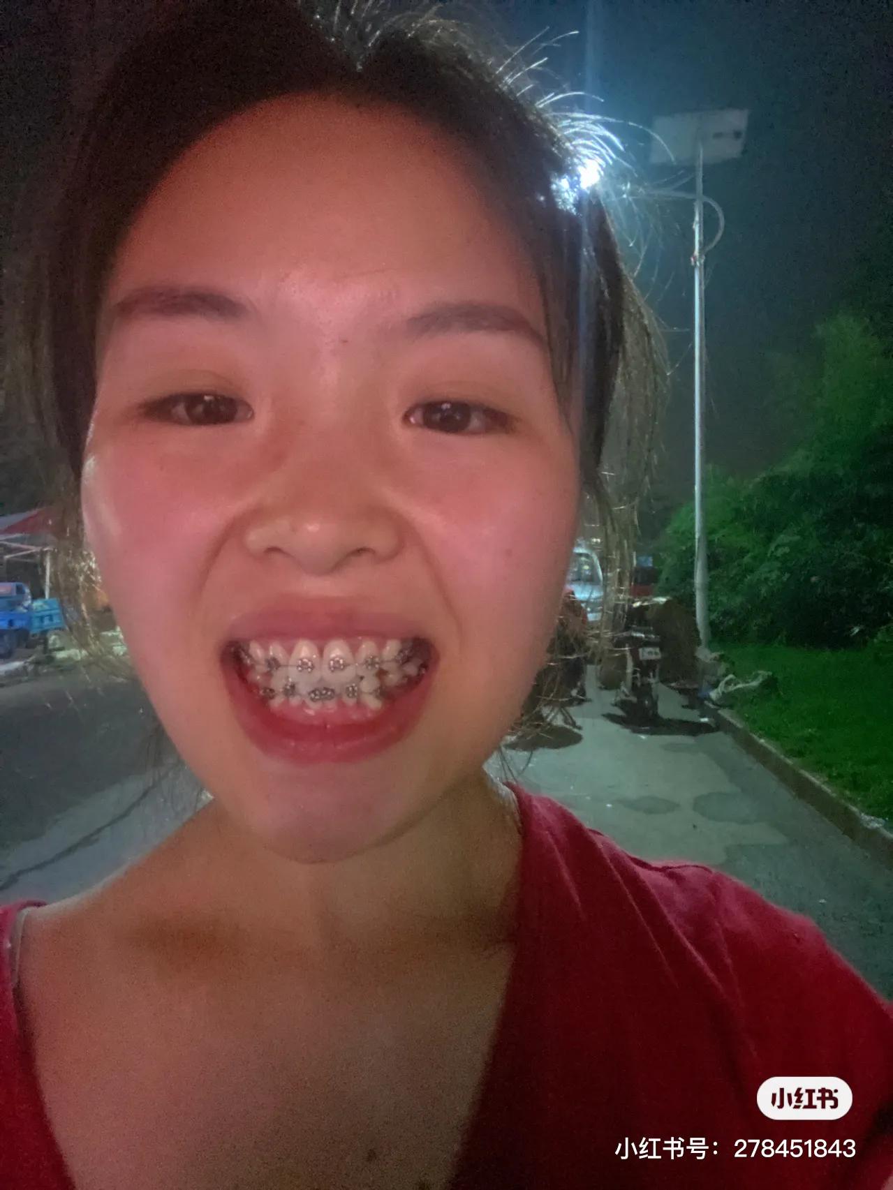 拔牙附近的牙隐隐痛酸是怎么回事,突然牙很酸痛是怎么回事