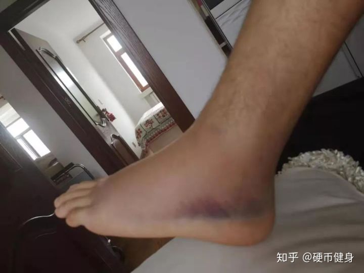 韧带损伤怎么治疗最有效,内侧副韧带损伤怎么治疗