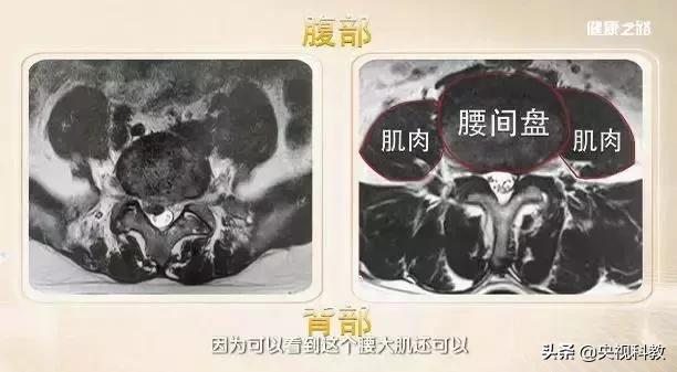 腰间盘突出怎么自我判定？怎么进行治疗？这篇文章告诉你