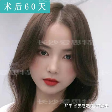 可以只开眼角不割双眼皮吗,双眼皮到底要不要开眼角