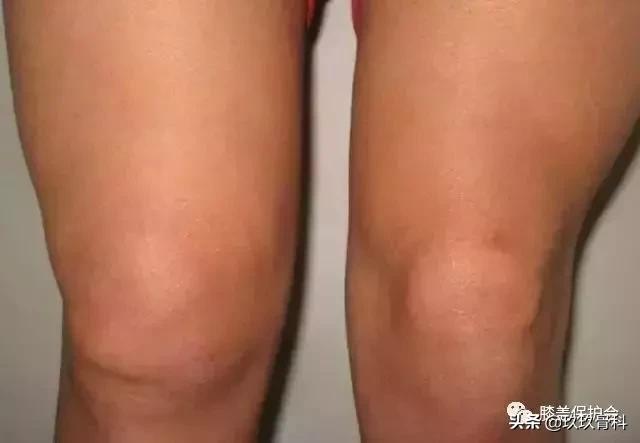 膝盖肿胀疼痛,滑膜炎找上门,要如何应对?