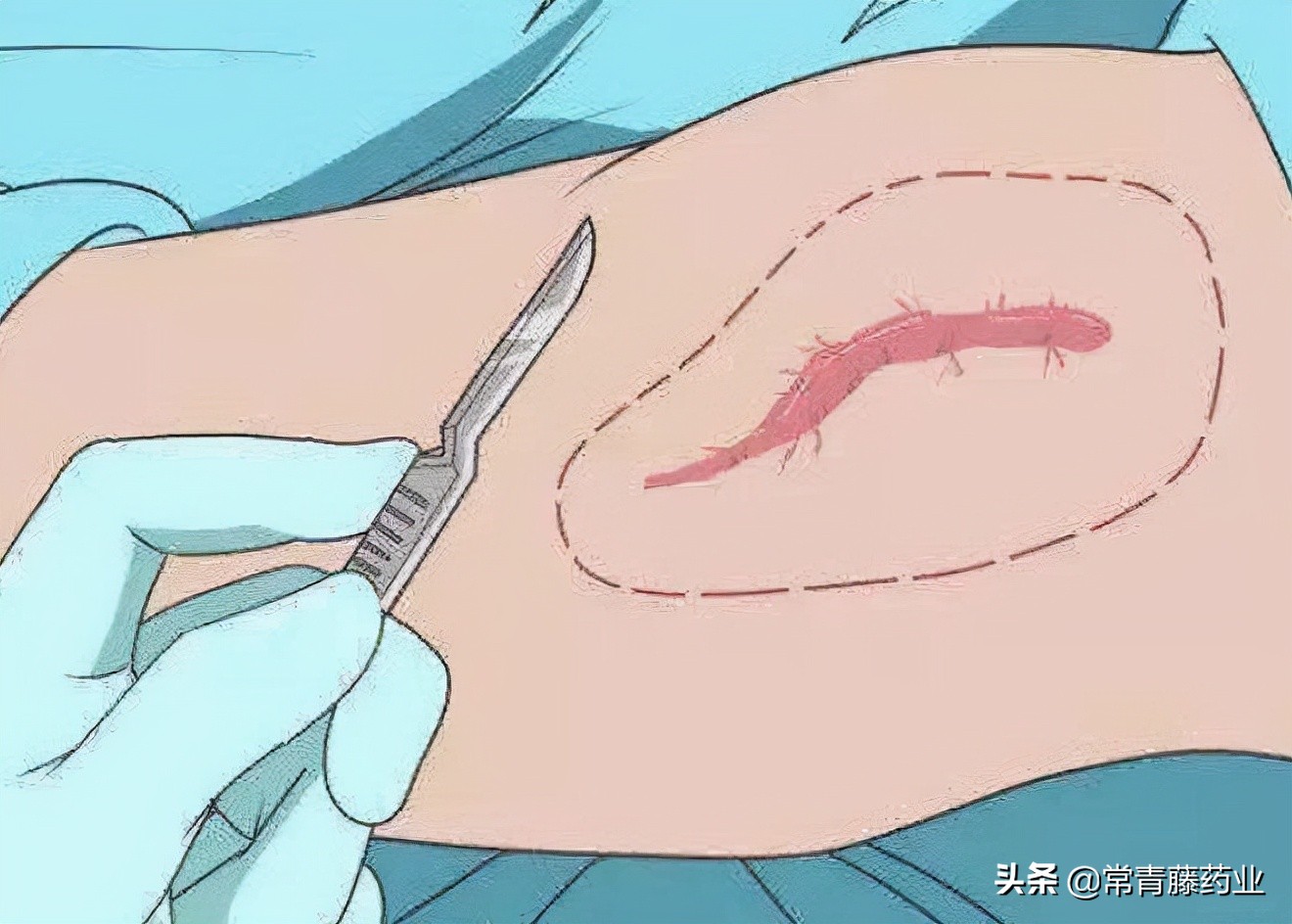 爱美之心，人皆有之，瘢痕的这些事是你想要知道的吗？