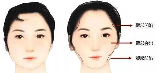 龅牙矫正牙套脸,牙套可以矫正脸歪吗