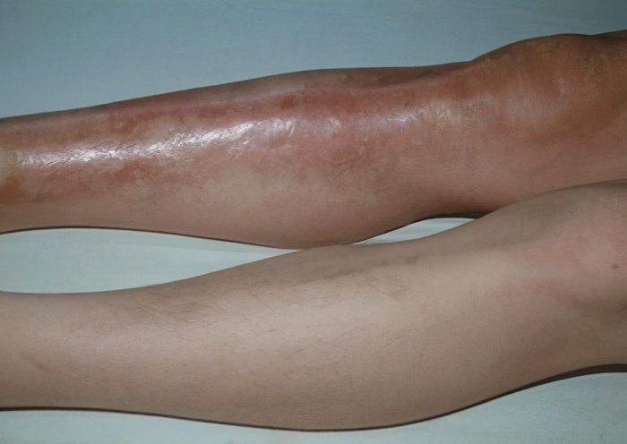 硬化性骨髓炎的临床症状,硬化性骨髓炎会遗传吗