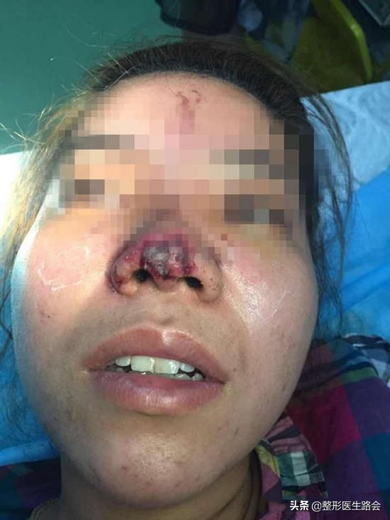 玻尿酸填充鼻子后悔了,玻尿酸注射后悔打溶解酶会不好吗