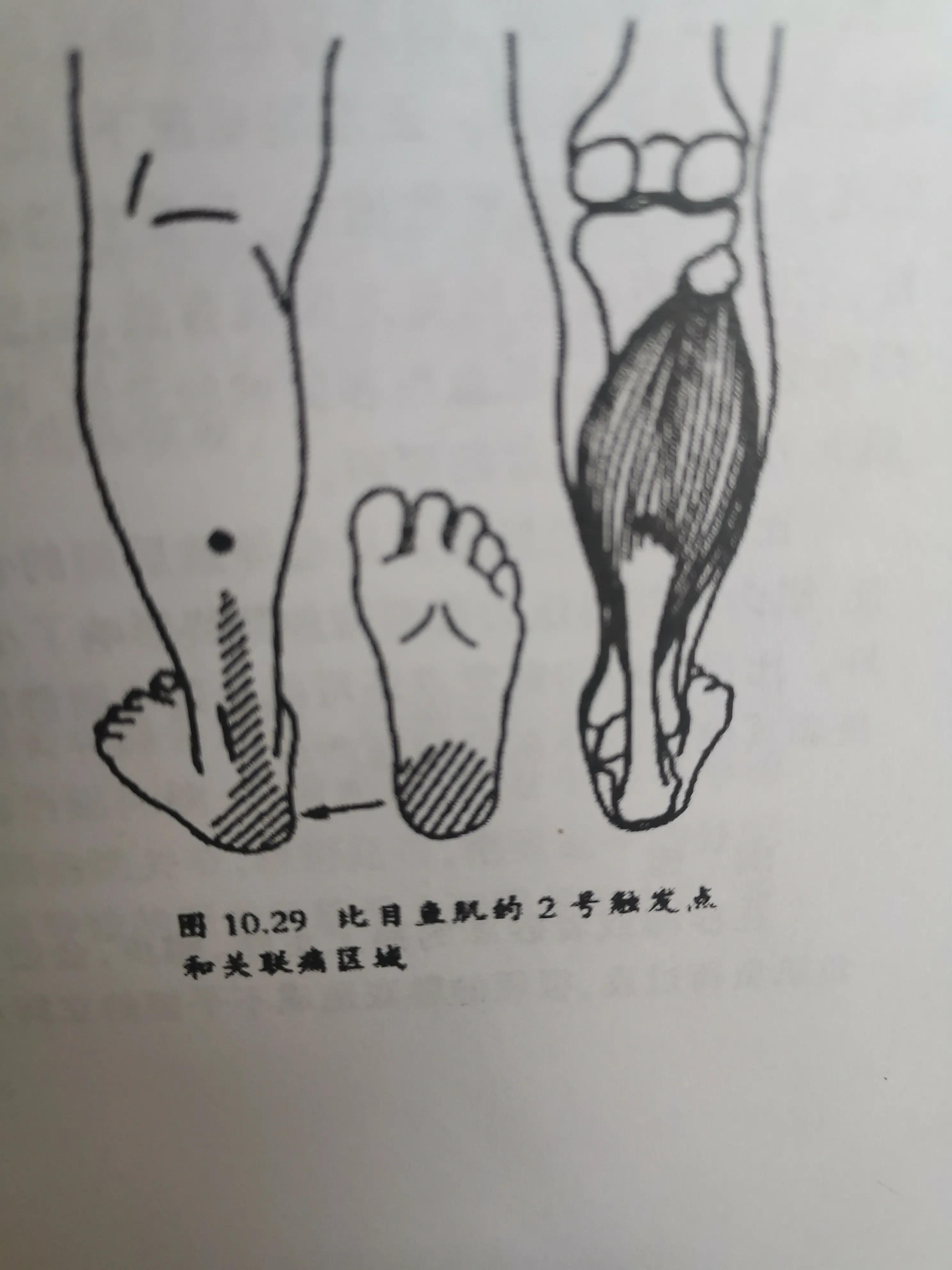 跟腱炎的自我治疗方法,跟腱炎最佳的物理疗法