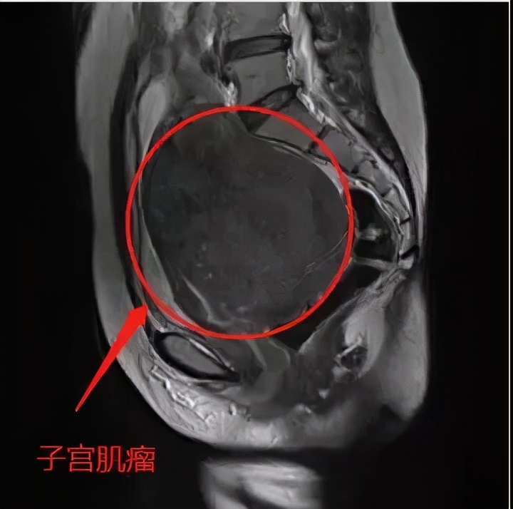 月经多是长了瘤吗,子宫肌瘤是福还是祸