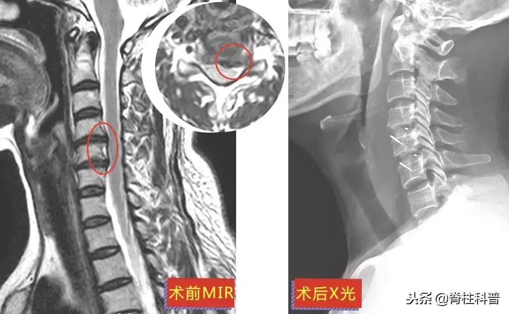 颈椎病治疗的分享,关于颈椎病通俗易懂的科普