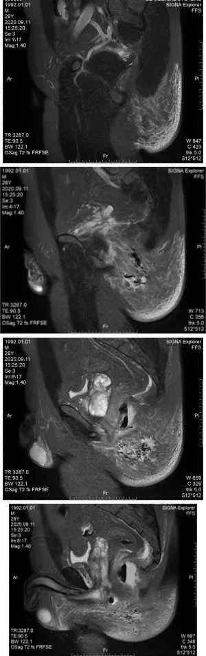 外阴坏死性筋膜炎,坏死性筋膜炎基础研究