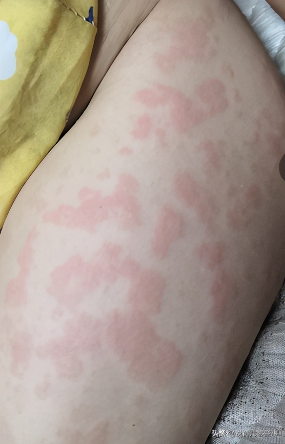 很恐怖的过敏图片,过敏发朋友圈的真实图片